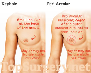 Double Incision Top Surgery  Top Surgery Center of Connecticut