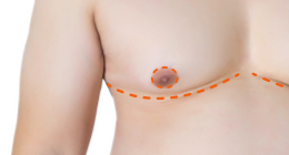 Double Incision Top Surgery