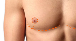 Inverted-T Top Surgery